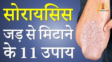 सोरायसिस का इलाज टॉप 11 घरेलू उपाय और परहेज सहित | psoriasis ka ilaj | psoriasis treatment in hindi 6 1690185422 maxresdefault