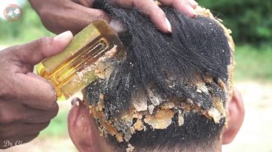 Best Scratching Dandruff (Big Flake) and Very Nice Flakes!! Dandruff Removal Satisfying#338 18 1690219704 maxresdefault