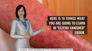 Treatment Of Eczema May Include 14 1690297760 maxresdefault