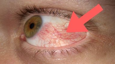 What is bleeding under the conjunctiva 10 1690462753 maxresdefault