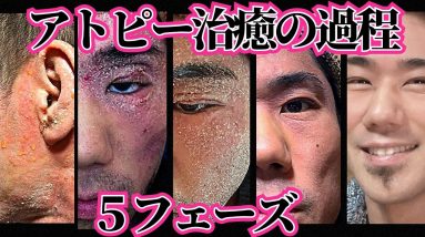【全部見せます】アトピー完全治癒までの5フェーズ 18 1690556127 maxresdefault