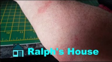 178. Psoriasis treatment (and eczema) - cheap 16 1690618763 hqdefault