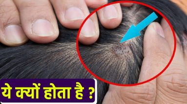 Scalp में Fungal Infection होने का Reason, Symptoms जानना जरूरी | Boldsky 16 1690648210 maxresdefault