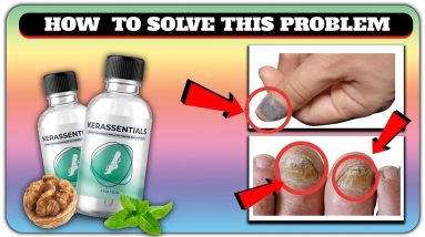 KerasSentials really work-Which toenail fungus treatment is the best-How long you use Kerassentials 14 1690649057 maxresdefault