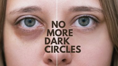 Remove Dark Circles : Fadeout Advanced Whitening Eye Defense Cream Day & Night 4 1690662752 maxresdefault