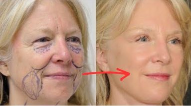SMILE LINES (LAUGH LINES) REMOVAL AND FILL WITH KOREAN FACE EXERCISE & MASSAGE IN 2 WEEKS 2 1690666399 hqdefault