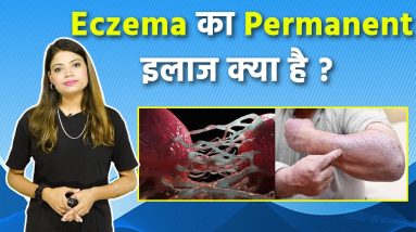 एक्जिमा का घरेलु इलाज क्या है | Eczema Ka Permanent Treatment Kya Hai | Boldsky 4 1690960516 maxresdefault