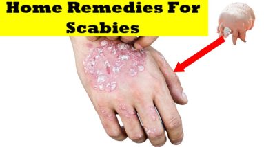 ✅scabies ||home remedy for scabies ||what is scabies || scabies symptoms ||how to get rid of scabies 4 1691076323 maxresdefault