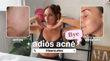 ADIÓS ACNÉ. ¿CÓMO CAMBIÉ MI PIEL? mi experiencia + rutina facial 6 1691103534 maxresdefault