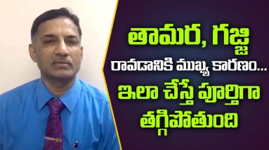 Ringworm: Fungal infections: Symptoms, types, and treatment in Telugu | Suman TV Health 14 1691137605 maxresdefault
