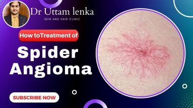 Spider Angioma cause and Treatment/ radiating blood vessels on skin / Dr Uttam Kumar Lenka 12 1691141251 maxresdefault