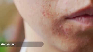 Buddha Natural Anti Acne Face Wash - 100% Ayush Certified - Combat Acne, Nourish. 16 1691306477 maxresdefault