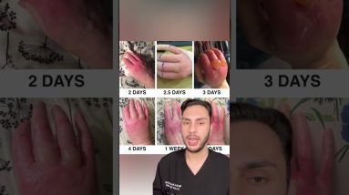 Limes Cause Blistering To The Skin | Phytophotodermatitis AKA Margarita Burn | MaximumSkin 18 1691313977 maxresdefault