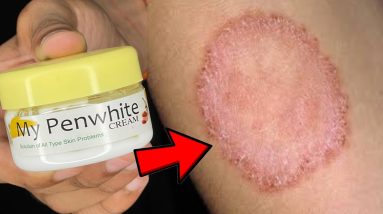 दाद खाज खुजली को जड़ से ख़त्म करने का उपाय | Ringworm | Eczema | dad khaz khuzli 16 1691316114 maxresdefault