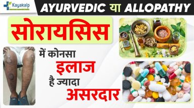 Ayurvedic या Allopathic, Psoriasis के लिए कोनसा Treatment Best है? | Kayakalp Psoriasis 16 1691596694 maxresdefault