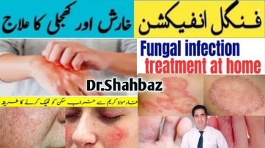 Fungal Infection Cream | Formula Cream Side Effects Treatment | Kharish Ka ilaj | Kharish Ki Cream 14 1691954359 hqdefault
