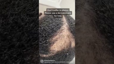 Hair loss/ Alopecia Help 2 1692265695 maxresdefault