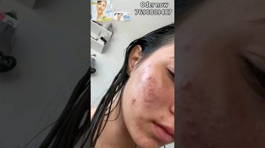 Pimples |Acne Treatment |acne Remover Cream How to remove dark spots on your face #ytshorts #shorts 2 1692376939 maxresdefault