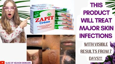 #HOWTO #TREAT #SKIN #INFECTIONS AT #HOME WITH ONE POWERFUL #CREAM, VISIBLE RESULTS IN #7days 12 1692468609 maxresdefault