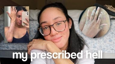 topical steroid withdrawal | experiencing hell on earth... 18 1692610899 maxresdefault