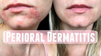 Perioral Dermatitis. How I treated it 4 1692703599 maxresdefault