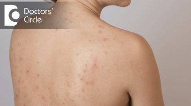 How long does a heat rash last? - Dr. Tina Ramachander 10 1692968026 maxresdefault