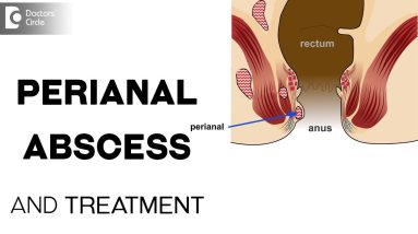 What is perianal abscess and its treatment? - Dr. Prashanth Varadaraju 2 1692971667 maxresdefault