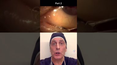 Dry eyes, blepharitis, meibomian gland dysfunction 14 1693069646 maxresdefault