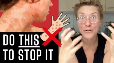 Atopic Dermatitis & Itchy Skin Rash - Do THIS! 6 1693213325 maxresdefault
