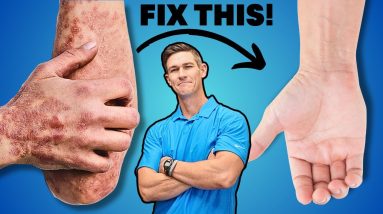 Psoriasis diet mistakes that shocked me! 20 1693514771 maxresdefault