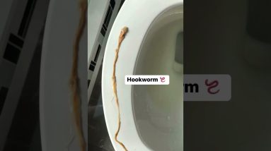 Intestinal Parasites, gallstones, mucoid plaque during live colon cleansing colonic irrigation 18 1694786190 maxresdefault
