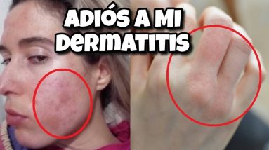 DERMATITIS ¿Funcionan las cremas? I Mi historia de sanación 2 1695155322 maxresdefault