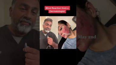 Accutane Reaction from a dermatologist #shorts 12 1695236230 maxresdefault