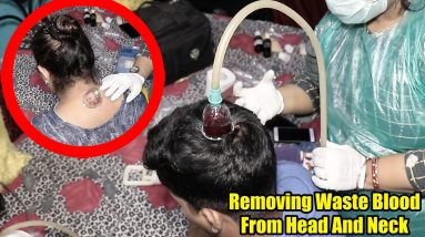 The Best And Easy Way To SOLVE ALL SKIN PROBLEM | #Hijama #CuppingThearpy 14 1695374090 maxresdefault