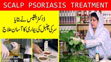 Scalp Psoriasis Treatment by Dr. Bilquis | Chambal ka Ilaaj | چنبل کی بیماری کا علاج 10 1695755579 maxresdefault