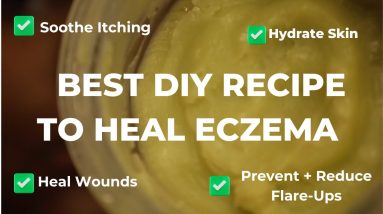 BEST DIY RECIPE FOR ECZEMA|SOOTHE ITCHINESS,HEAL WOUNDS+DRY SKIN,REDUCE FLARE-UPS|HOW TO HEAL ECZEMA 4 1695762926 maxresdefault