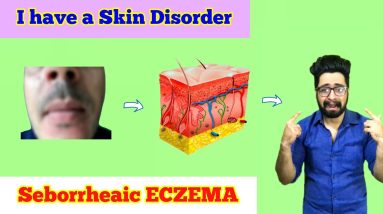 I have a SKIN Disorder | SEBORRHEAIC ECZEMA | the REAL Truth | #skinproblems #skindisorder 10 1699088777 maxresdefault