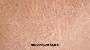 Dr. Nermeen Bedair lectures for undergrad. Dry skin 14 1699556167 maxresdefault