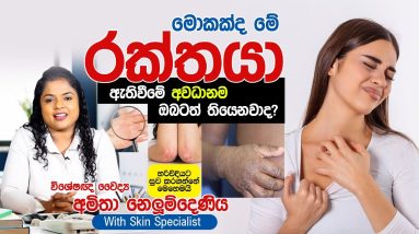 රක්තයා නැතිකරගන්න හරිම විදිය | Eczema | Skin Specialist 20 1699649711 maxresdefault