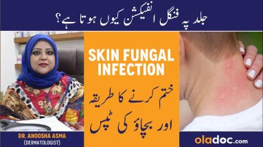 Skin Fungal Infection Treatment In Urdu/Hindi- Dad Khad Ka Ilaj - Skin Pe Fungus Kese Hota Hai 4 1699669982 maxresdefault