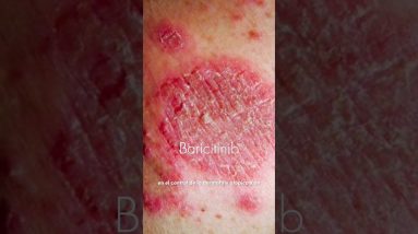 Dermatitis atópica tratamientos #onderm #dermatologo #dermatologomonterrey #cuidadodelapiel #shorts 4 1700638883 maxresdefault