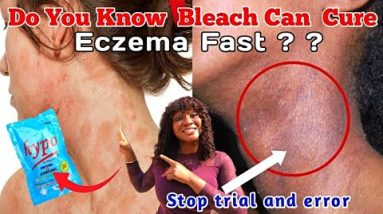 What are Bleach Bathe : How to use Bleach to get rid of Eczema on your skin. #skincare #affordable 4 1702001940 hqdefault