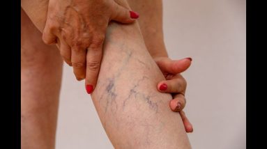 Improve #circulation, #preventlegs #chronic #venous #varicose veins #hemorrhoids #Flavonoids 4 1702192964 maxresdefault