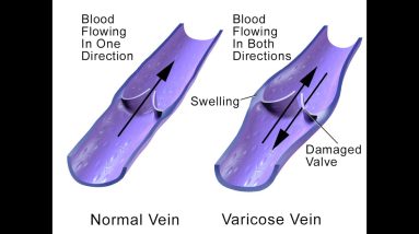 Improve #circulation, prevent chronic #venous heavy #legs, #varicose veins #hemorrhoids #Flavonoids 2 1702351267 maxresdefault