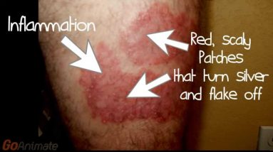 Best Psoriasis Treatment Information and Remedy Ever! 6 1702521575 maxresdefault