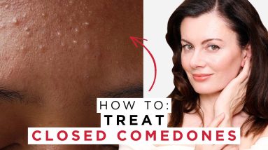 How To Treat Closed Comedones | Dr Sam Bunting 18 1702904758 maxresdefault