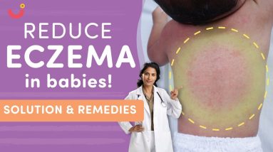 Eczema in Babies: Causes, Symptoms, and Natural Treatment | Infant Eczema Home Remedies 14 1702927280 maxresdefault