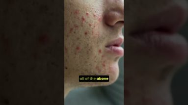 Eczema flares can be uncomfortable, but is it infected? 12 1765597608 maxresdefault