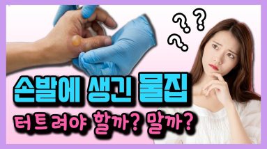 한포진으로 손발에 물집 생겼을 때 효과적인 치료법 - 박치영의 피부 톡톡 #05 물집 제거, 수포 치료법! 12 1765846924 maxresdefault