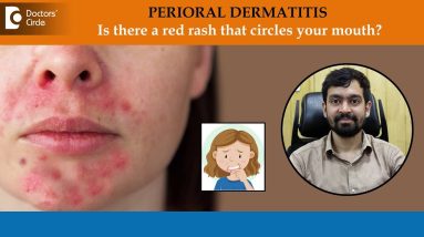 Tiny red bumps or rashes around mouth | Perioral Dermatitis- Dr. Rajdeep Mysore | Doctors' Circle 18 1771851286 maxresdefault
